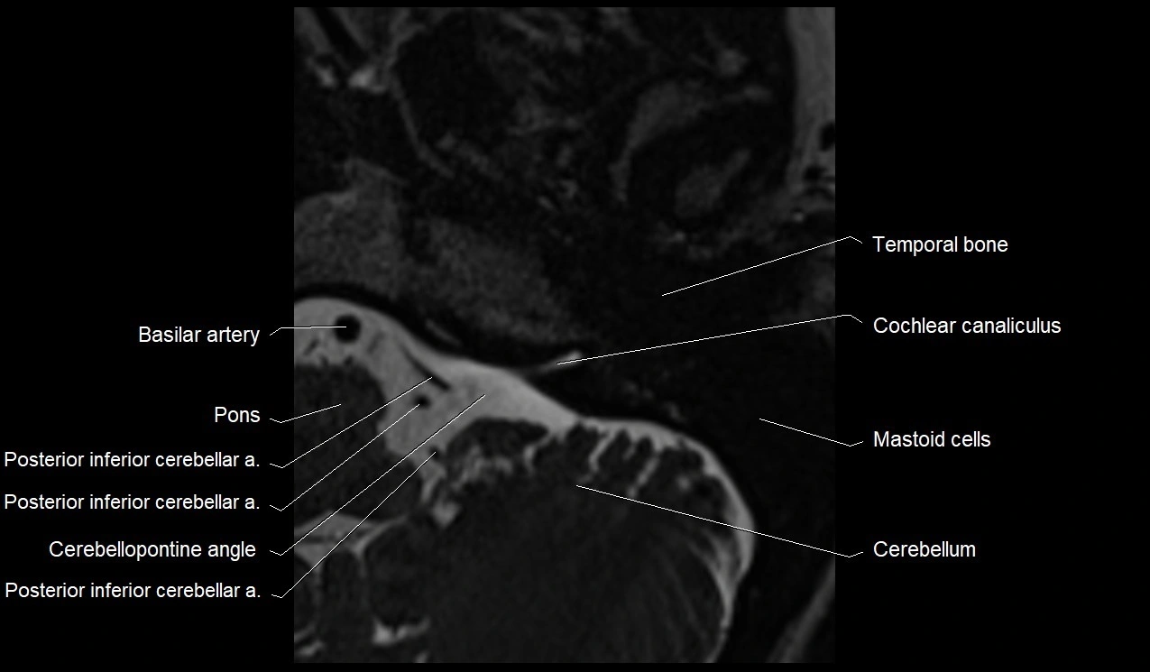 Internal auditory canal (IAC) axial cross sectional anatomy image 1.webp